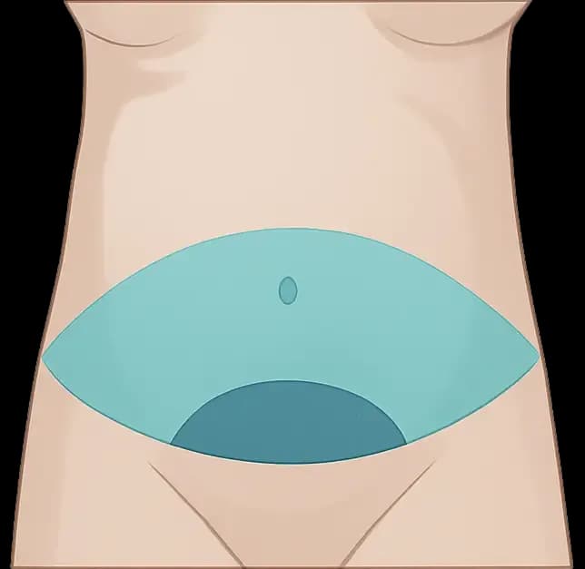 Illustrasjon av området en mini bukplastikk behandler
