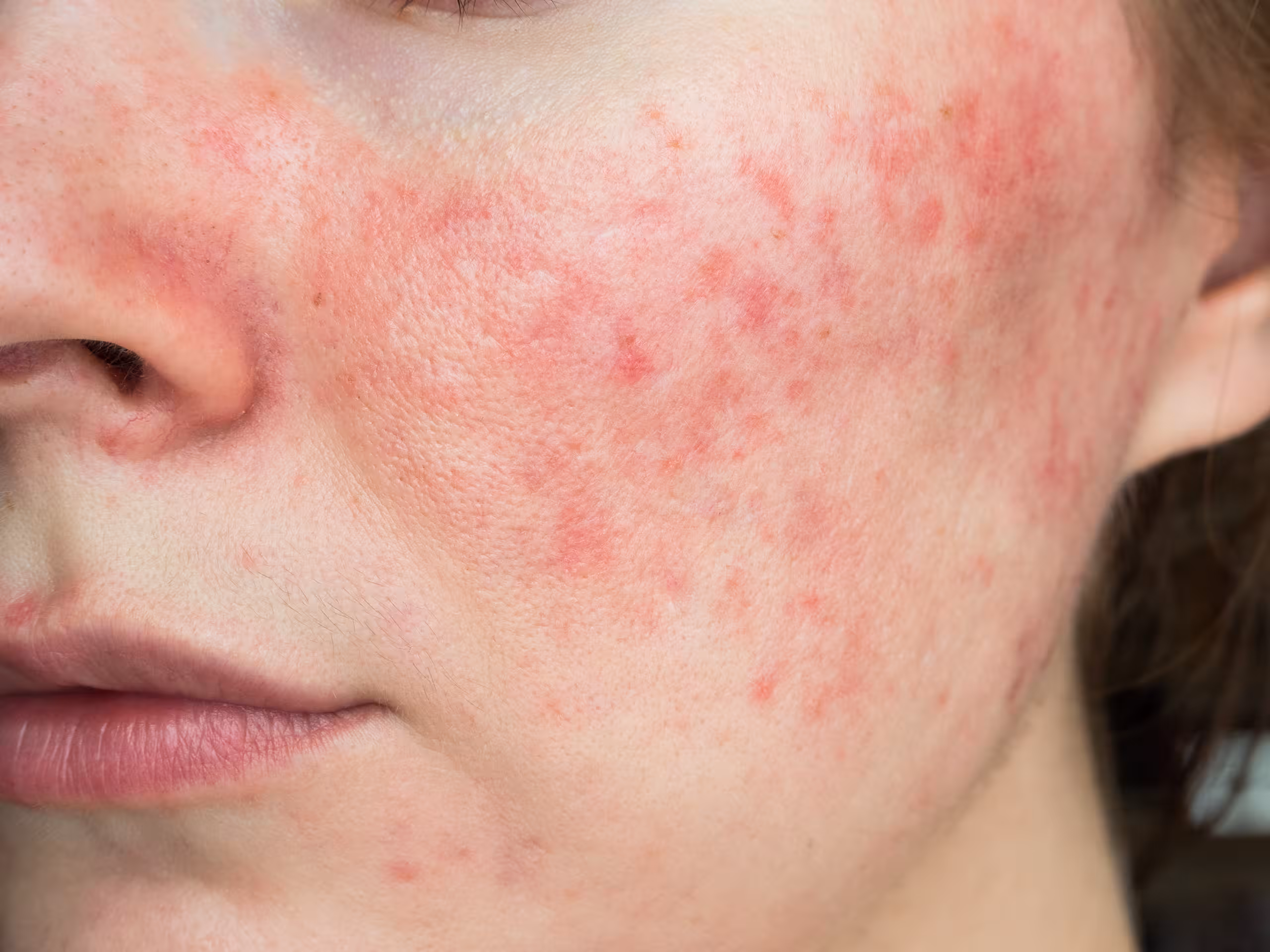 Kinn med rosacea og rød hud