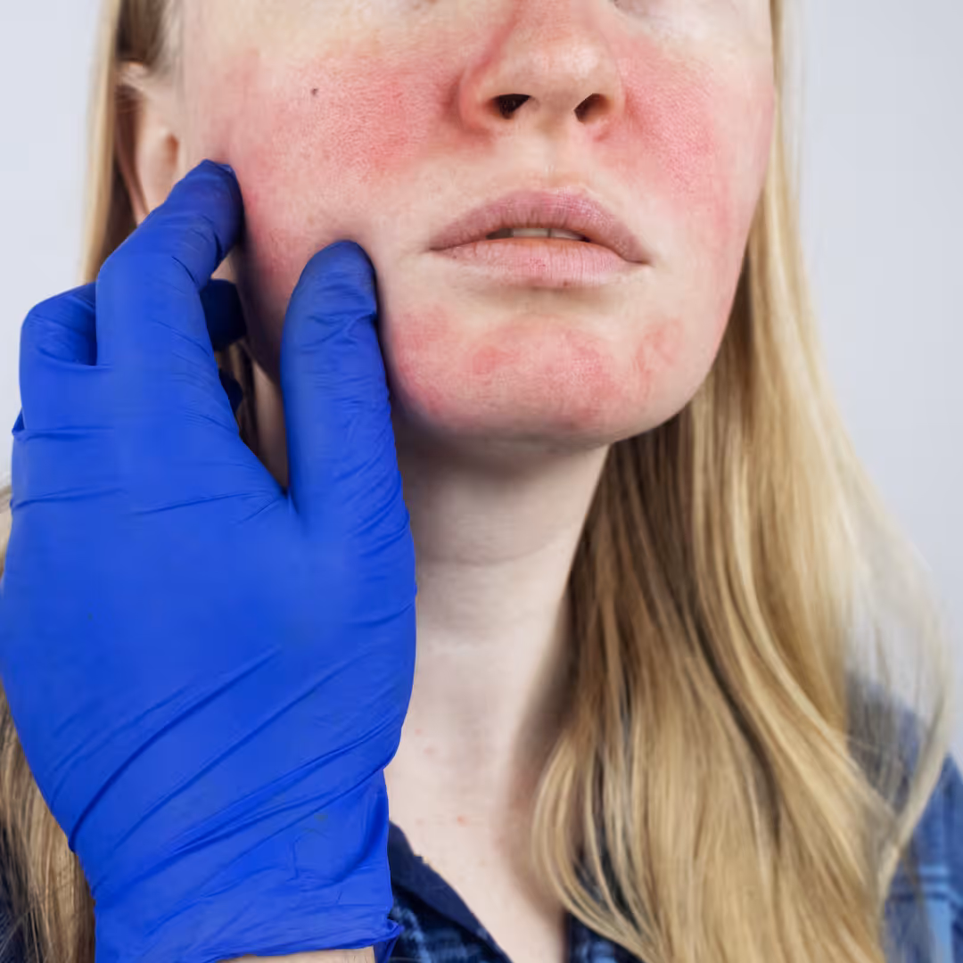 Lege med hansker undersøker et ansikt med rosacea