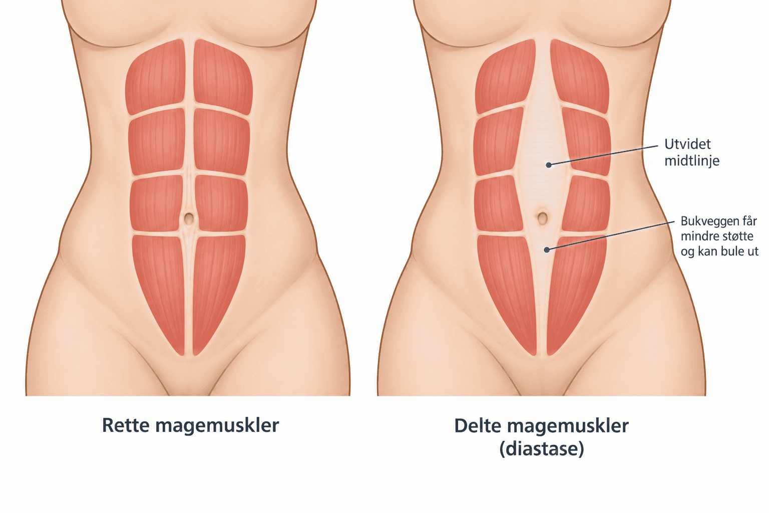 Illustrasjon av rette magemuskler og delte magemuskler (diastase) med utvidet midtlinje