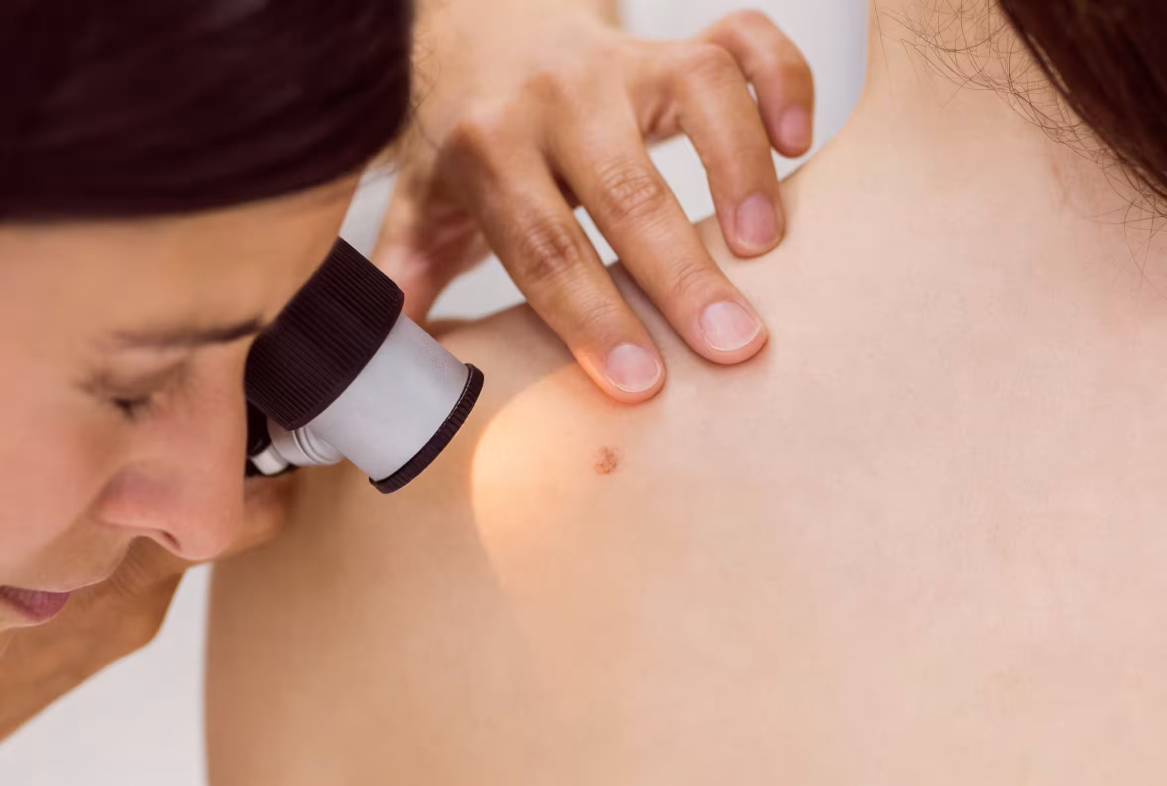 Lege undersøker en føflekk med dermatoskop